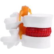 Human Anatomical Lumbar Disc Herniation Model - D5QC icon