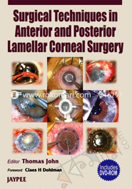 Surgical Techniques in Anterior and Posterior Lamellar Corneal Surgery image