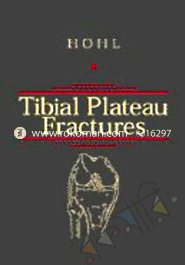 Tibial Plateau Fractures image