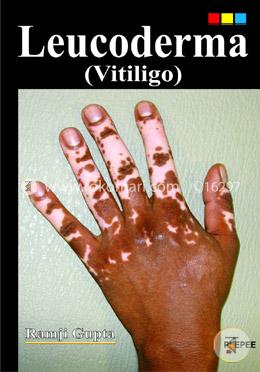 Leucoderma (Vitiligo)