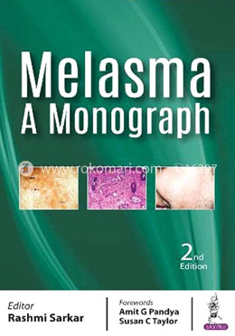 Melasma - A Monograph image
