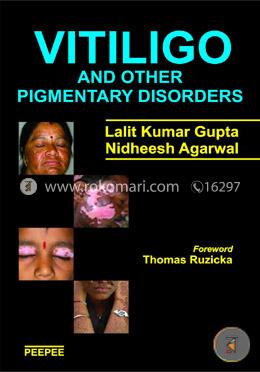 Vitiligo and Other Pigmentary Disorders