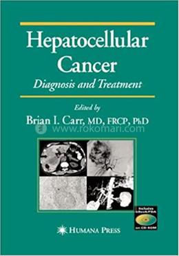 Hepatocellular Cancer: Diagnosis and Treatment