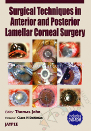Surgical Techniques in Anterior and Posterior Lamellar Corneal Surgery