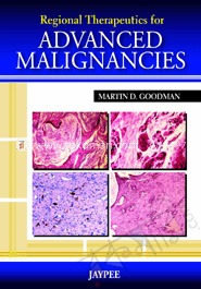 Regional Therapeutics For Advanced Malignancies