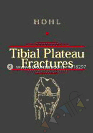 Tibial Plateau Fractures 