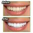 Miracle Teeth Whitener - 20 gm image