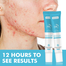 Mooyam Salicylic Acid Remove Acne Gel 20 gm image